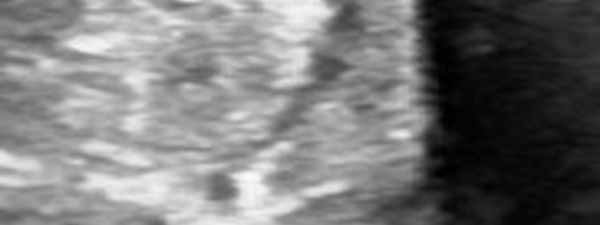 Fissuration du tendon court fibulaire